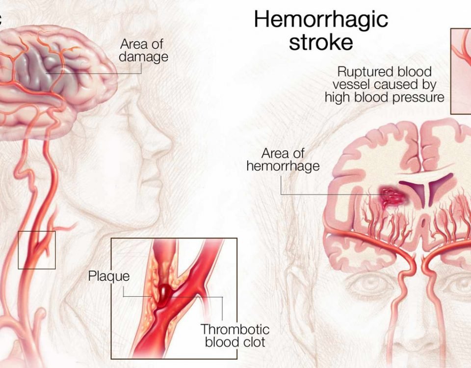 Stroke-Treatment-in-Indore