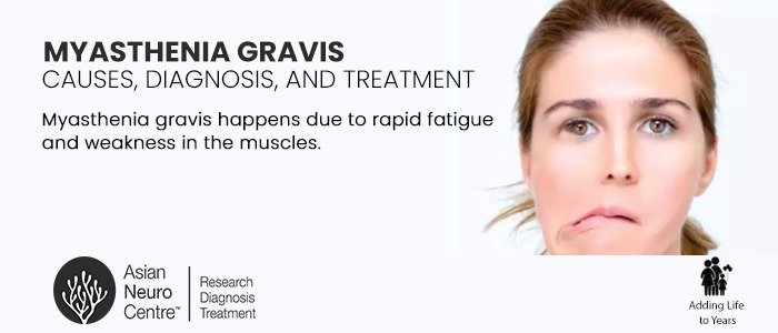 Myasthenia Gravis Causes, Diagnosis, and Treatment, asianneurocentre.com