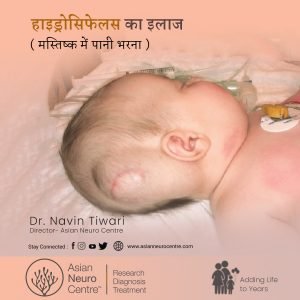 दिमाग में पानी भर जाने का इलाज | Hydrocephalus Treatment in Hindi
