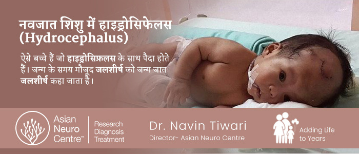 नवजात शिशु में जलशीर्ष | Hydrocephalus in Newborn in Hindi