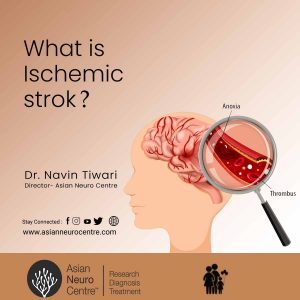 What is Ischemic stroke?, Causes, Symptoms, Diagnosing, Treatment & More